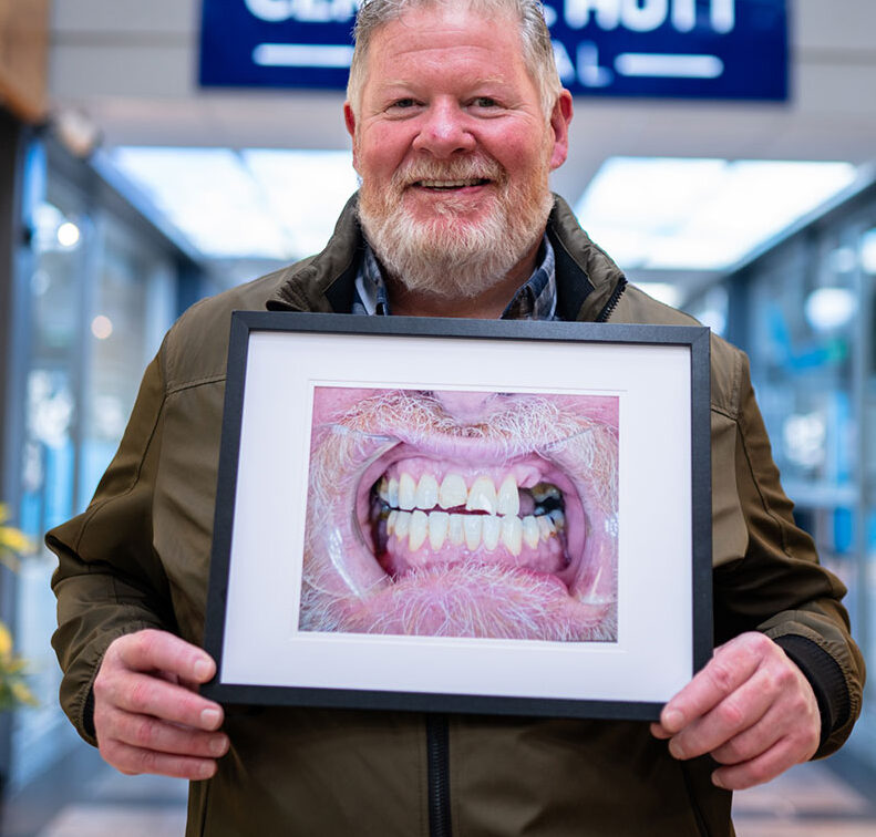 patient showing a before photo of his teeth before his dental implant procedure