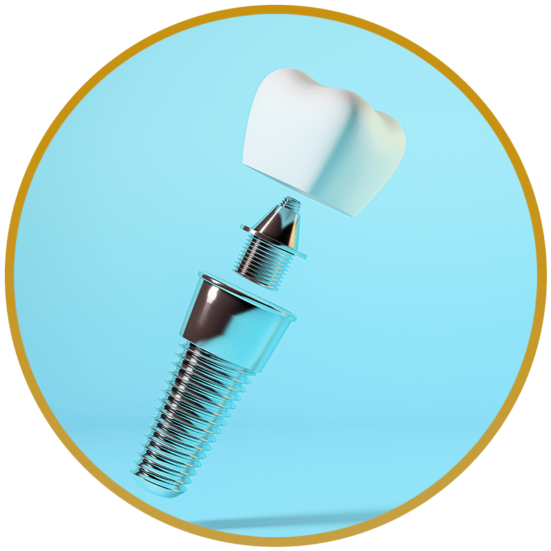 dental implant